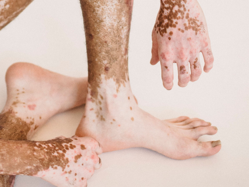 Traitement du psoriasis en Espagne avec Doctor Home Visit : Télémedecine de qualité et médecins à domicile disponibles tous les jours.